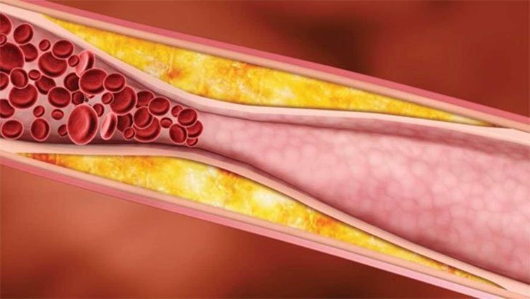 Máu nhiễm mỡ là gì? Cách ăn kiêng cho người bị máu nhiễm mỡ