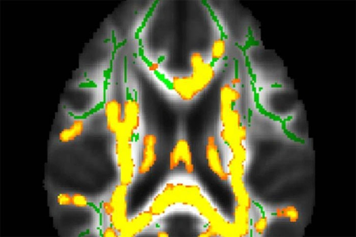 Mỡ bụng cảnh báo bệnh Alzheimer?