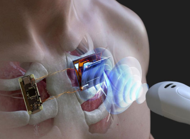 Nghiên cứu mới giúp sạc pin máy tạo nhịp tim mà không cần phẫu thuật