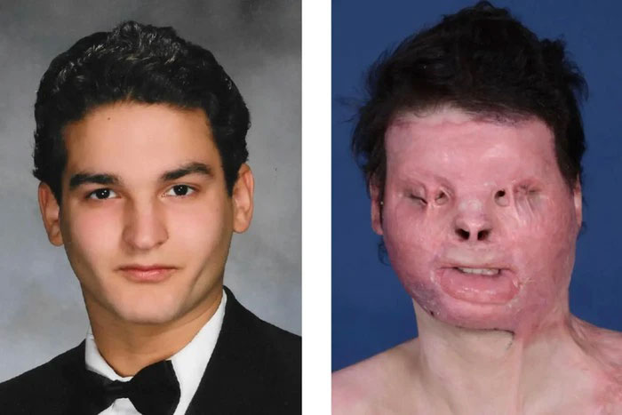 Người đầu tiên trên thế giới được phẫu thuật ghép mặt: Cuộc sống thay đổi thần kỳ sau 3 năm!