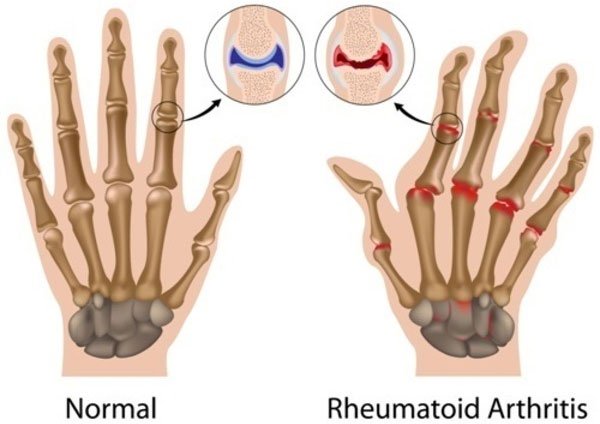 Nguyên nhân và những yếu tố nguy cơ của viêm khớp dạng thấp (Phần 1)