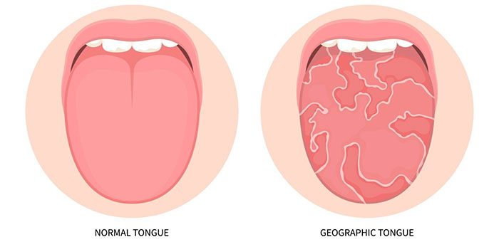 Những đặc điểm kỳ lạ của lưỡi người: Hiện tượng lưỡi xúc tu, lưỡi bản đồ và lưỡi nứt
