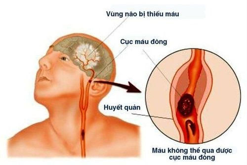 Những điều cần biết bệnh nhồi máu não