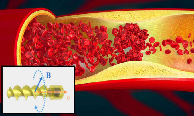 Robot xoắn ốc bơi trong mạch máu để phá máu đông