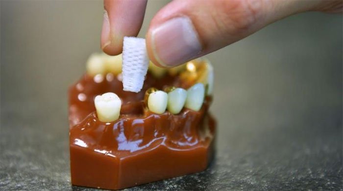 Rút ngắn thời gian trồng răng giả nhờ chân răng 3D