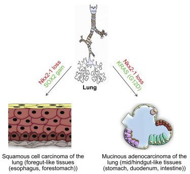 Sự kì dị của ung thư: Khi lá phổi bị biến thành dạ dày và ruột