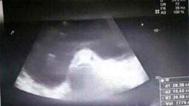 Sự thật đáng sợ đằng sau bức ảnh siêu âm "người mang thai cá"