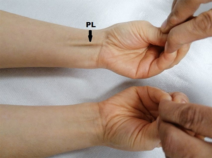 Tại sao một số người không có cơ palmaris longus (cơ gan tay)?