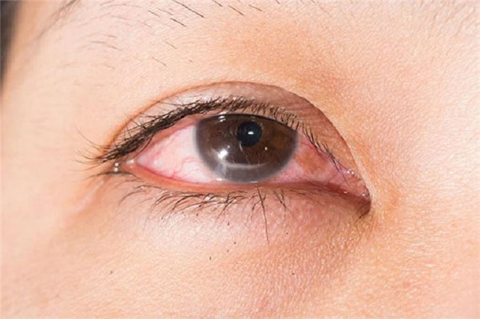Tại sao viêm mũi xoang lại có thể gây mù mắt?