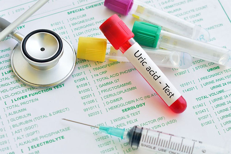 Tăng axit uric máu: Nguyên nhân, triệu chứng và cách điều trị