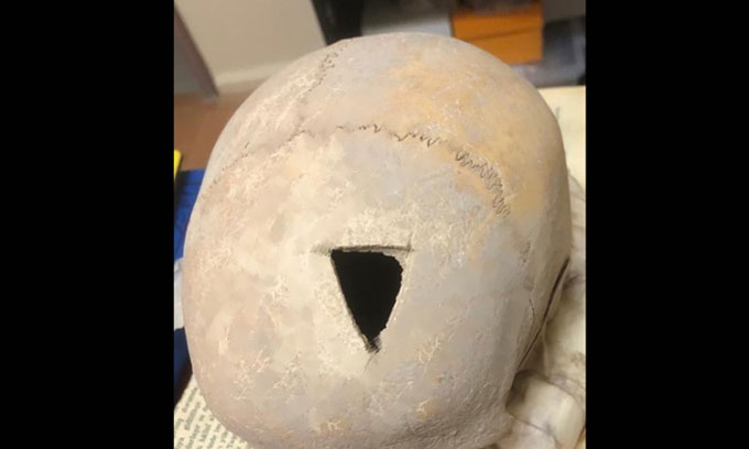 Tìm thấy hộp sọ bị khoan lỗ 3.200 năm trước ở Thổ Nhĩ Kỳ