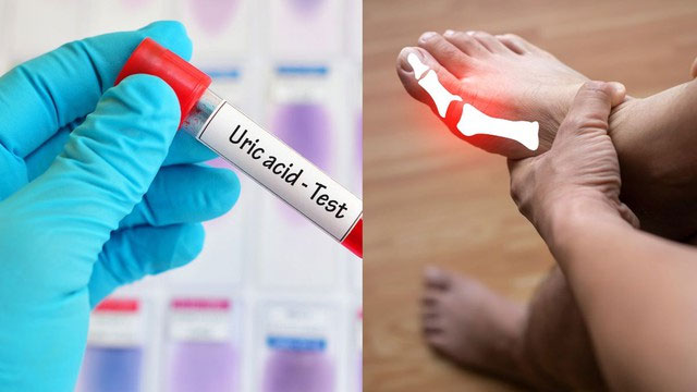 Top 10 cách đào thải acid uric một cách tự nhiên, ngừa gout hiệu quả: Nhiều người chưa biết để làm!