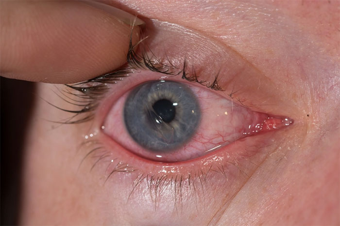 Top 10 nguyên nhân gây đỏ mắt và cách điều trị