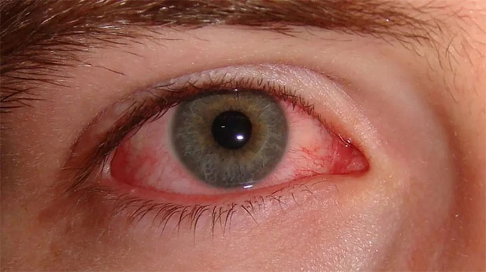 Top 10 nguyên nhân gây đỏ mắt và cách điều trị