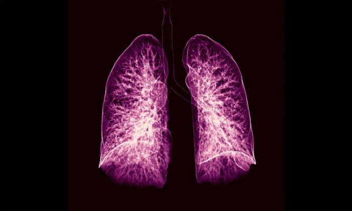 Trí tuệ nhân tạo có thể chẩn đoán ung thư phổi sớm tới một năm