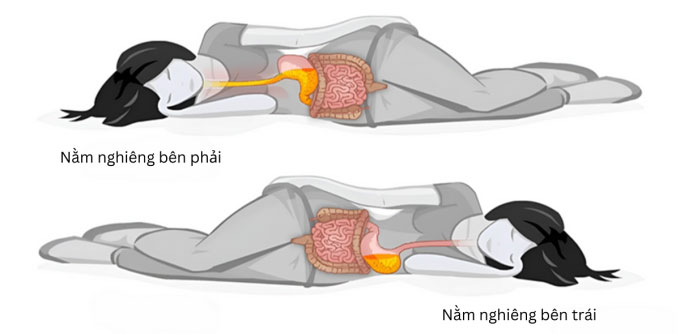 Tư thế ngủ giúp giảm khó tiêu, trào ngược