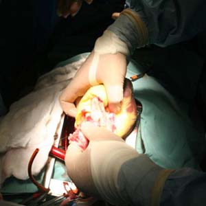 Bác sĩ người Việt ghép tim thành công