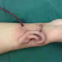 Bác sỹ Trung Quốc nuôi cấy tai trên tay bệnh nhân
