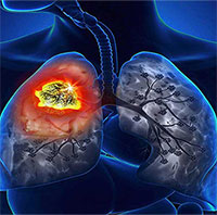Bệnh bụi phổi silic là gì?