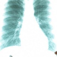 Bệnh nhân ung thư phổi di căn khắp cơ thể vẫn chữa khỏi