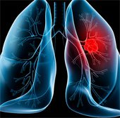 Bệnh ung thư phổi và các giai đoạn