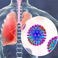 Bệnh viêm phổi là gì?
