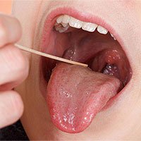 Các giai đoạn của ung thư lưỡi và cách điều trị