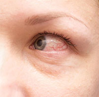 Các loại dị ứng mắt và triệu chứng để phân biệt chính xác nhất