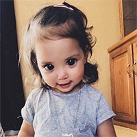 Căn bệnh ẩn sau đôi mắt to tròn của bé hai tuổi