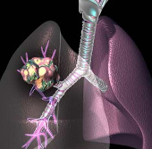 Canada áp dụng công nghệ 3D điều trị ung thư phổi