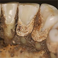 Cao răng tiết lộ thói quen dùng thuốc của người xưa