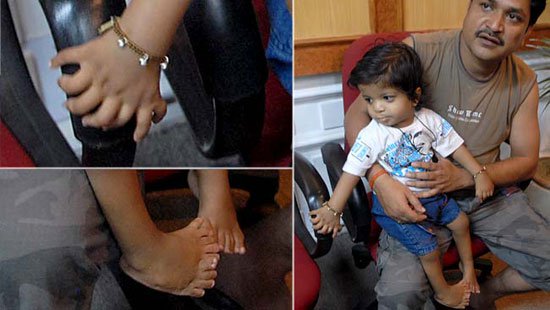 Cậu bé có 34 ngón tay, chân ở Ấn Độ
