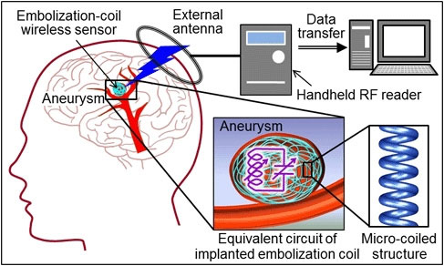Cấy ghép ăng ten không dây để theo dõi chứng phình động mạch não
