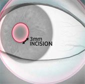 Công nghệ kính áp tròng mới cấy ghép trực tiếp vào mắt