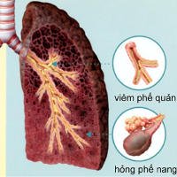 Dấu hiệu nhận biết sớm ung thư phổi