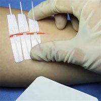 Dermaclip - Miếng dán vết thương cho những người sợ đau