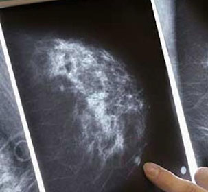 Điểm tương đồng giữa ung thư vú và buồng trứng