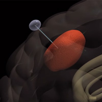 Đột phá thiết bị ‘nhử’ tế bào ung thư khỏi não bộ