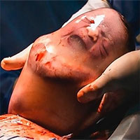 Em bé bĩu môi khi sinh ra trong bọc ối còn nguyên vẹn