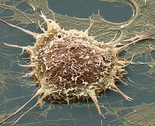 Giấm giúp phát hiện ung thư cổ tử cung