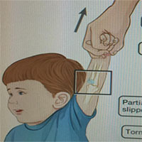 Kéo giật tay trẻ đột ngột dễ làm trật khớp khuỷu