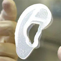 Lần đầu tiên trên thế giới: In 3D tai người, cấy ghép thành công cho cô gái