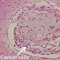 Nghiên cứu mới: Biến tế bào ung thư thành tế bào gốc, giúp chế thuốc chữa bệnh
