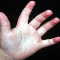 Nguyên nhân và cách đối phó khi trẻ ra nhiều mồ hôi tay, chân