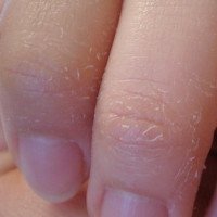Những bệnh về da vào mùa lạnh dễ tái phát