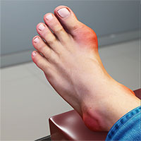 Phân biệt bệnh Gout và bệnh viêm khớp dạng thấp