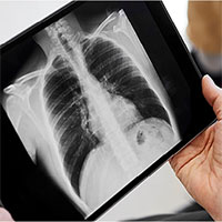 Phát hiện mới về nguyên nhân gây ung thư phổi