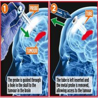Phương pháp phẫu thuật u não không cần tách hộp sọ