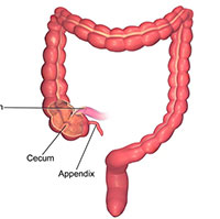 Ruột thừa: Bộ phận tưởng chừng 