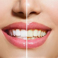 Tại sao răng chúng ta bị ngả sang màu vàng?
